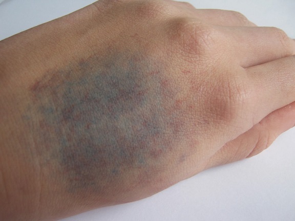 Why Do Bruises Turn Yellow New Health Advisor